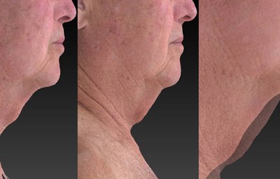 Before and after at one 20-minute bilateral UltraSlim treatment